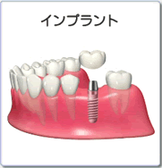 インプラント療法：専門的かつ最適な治療が受けられる