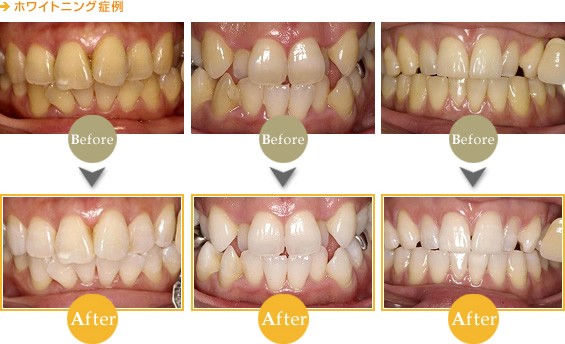 ホワイトニング症例