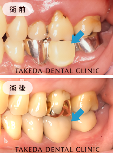 ブリッジを外してインプラントを1本入れた症例です
