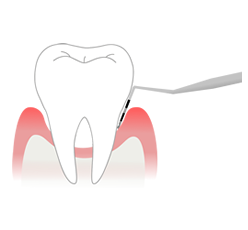 歯周ポケット検査