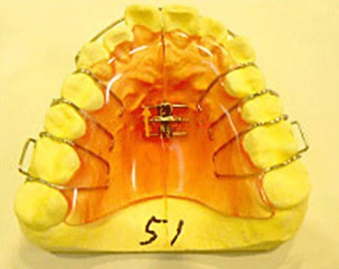 将来的な咬み合わせの安定と口元の調和を見据え、段階的に矯正を進めていきます。