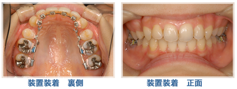 舌側矯正は周りから気づかれにくい矯正方法です