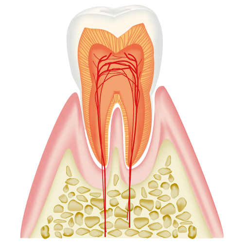 虫歯菌が感染した歯髄を取り除き、歯の内部に侵入した細菌をきれいに除菌
