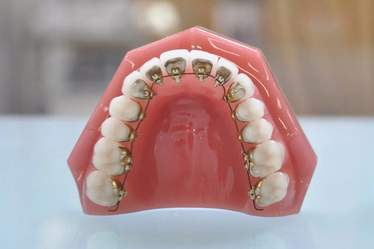 歯科矯正用アンカースクリューを用いた独自の矯正法