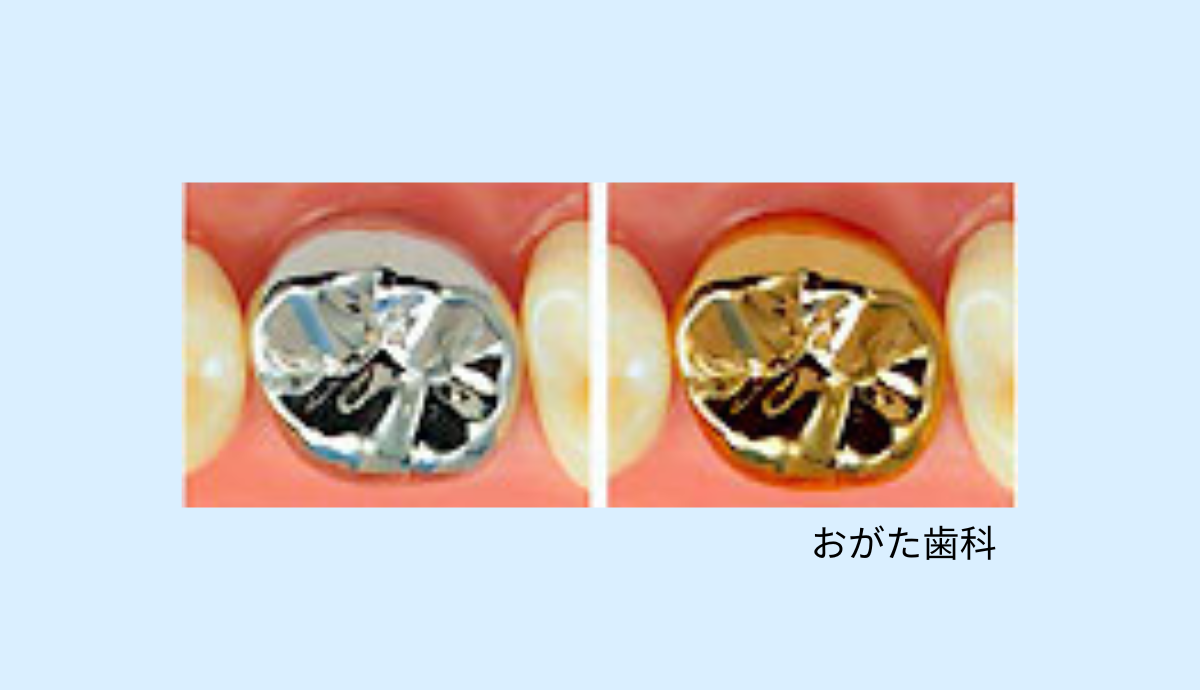 おがた歯科の補綴治療