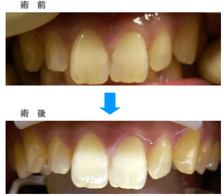 黄ばみが気になる方や、美しい笑顔を手に入れたい方におすすめです。