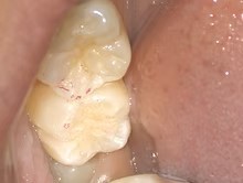 虫歯治療の術後