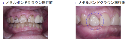 メタルボンドクラウン施行前と施行後