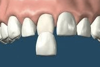 審美歯科は見た目を美しくすることと口内環境をすこやかに保つことを兼ね備えています