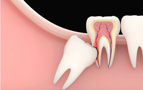 親知らずに関する不安や疑問がある方は、お早めにご相談いただければと思います。
