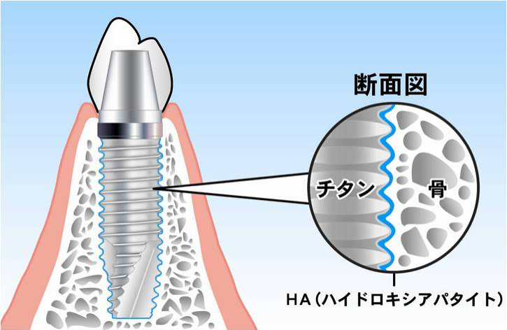 先進技術で支える安心のインプラント治療