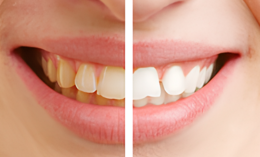 高品質な素材と技術で理想的な口元美を実現するホワイトニングと審美治療