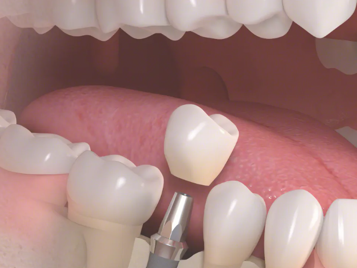 各患者様の状態に合わせた個別のカウンセリングを行い、最適なインプラント治療プランをご提案します。