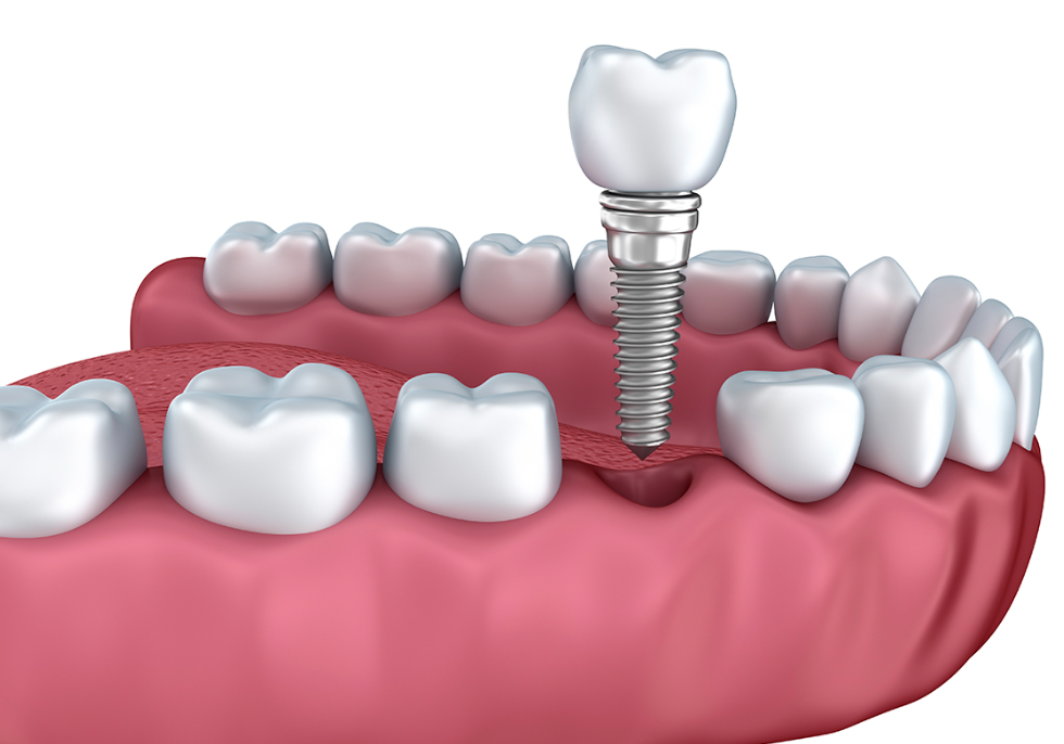 姉妹医院と連携した確かな技術でインプラント治療を提供