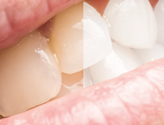 白い歯を取り戻すホワイトニング