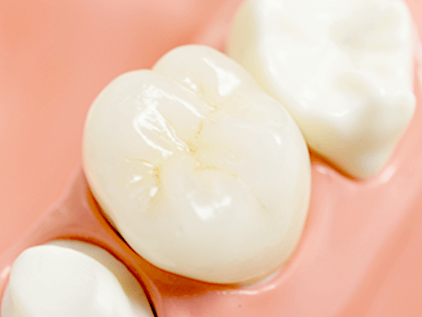 もう悩まないセラミック治療で美しい口元へ