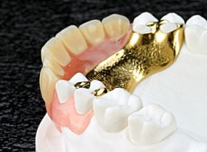 スマートデンチャーを採用