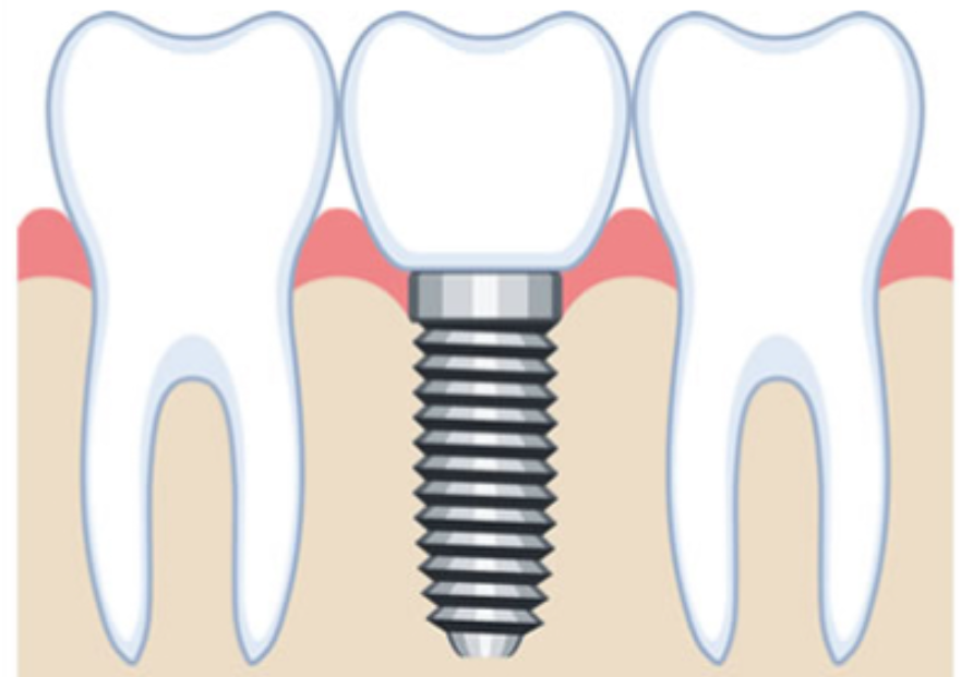 AQBインプラントシステムで安全性と効率性を両立した先進治療を提供