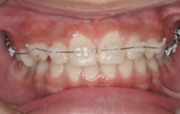 部分矯正や見た目に配慮した治療をお考えの方は、セラミックブラケット矯正をぜひご検討ください。