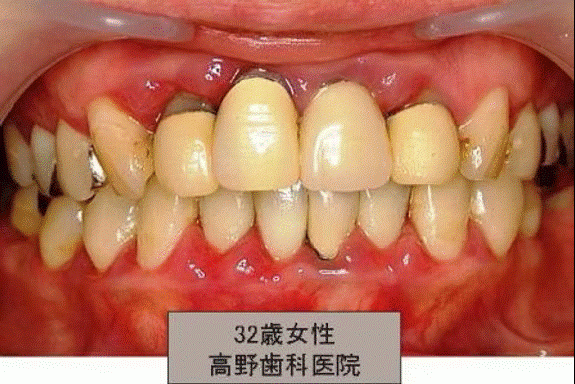 歯周病治療を通して歯を守り、全身の健康維持にもつなげます。