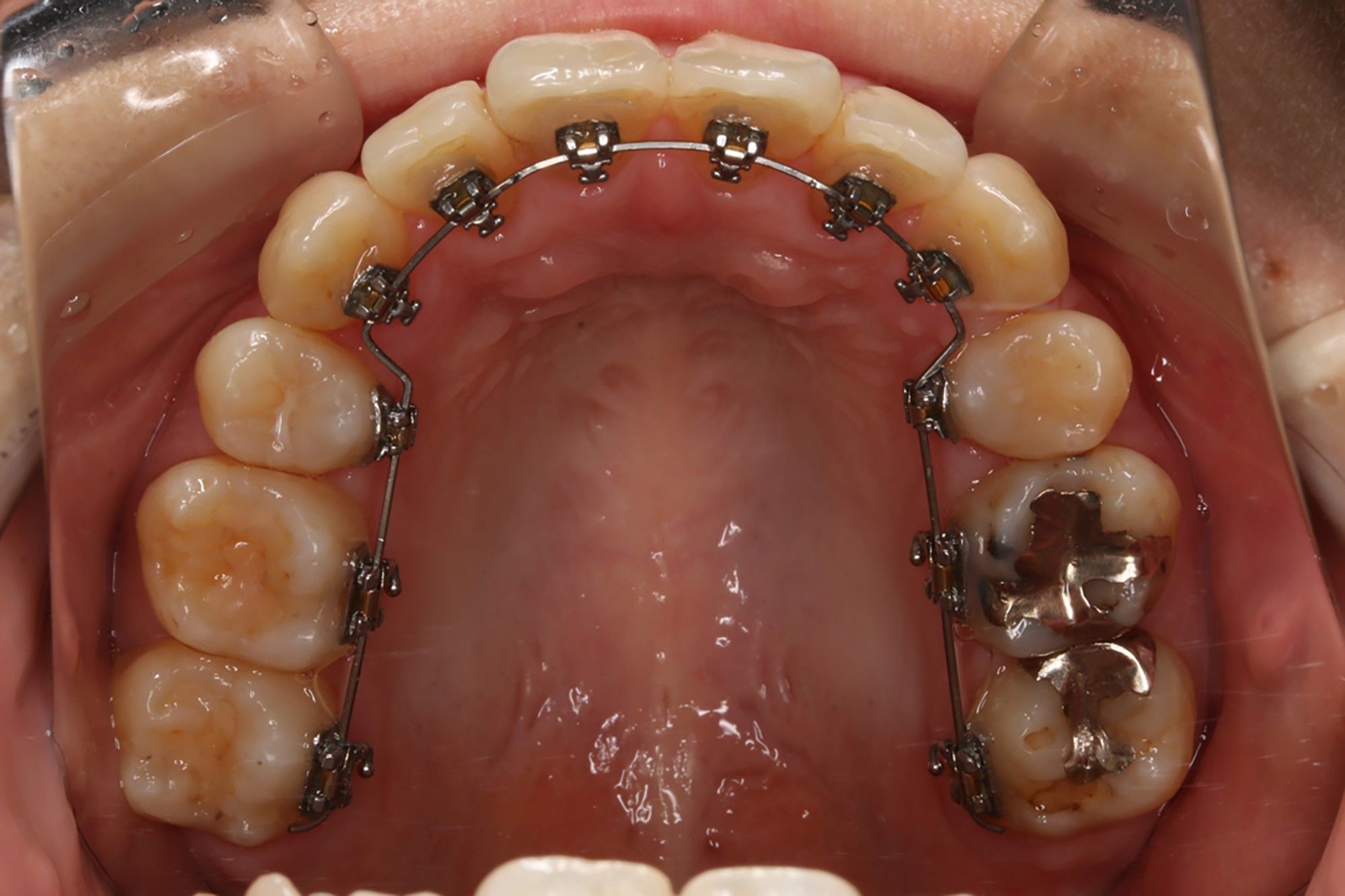 装置の見た目や負担の少なさにも気を配りながら矯正を進める