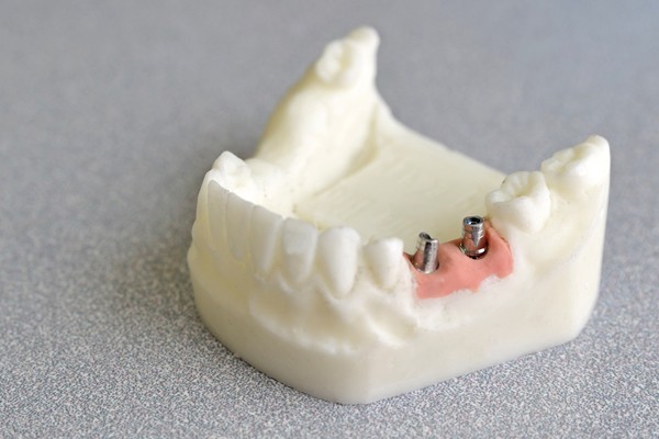 自分の歯のように噛める喜びへ
