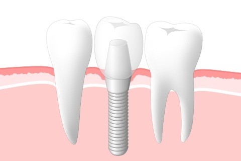 失った歯の機能と審美性の回復を図り、日常生活の質向上につなげる選択肢として提案しています。