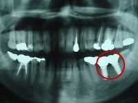 「インプラントありき」ではなく、入れ歯・ブリッジも含めた総合的な検討からスタートします