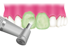 担当歯科衛生士が丁寧にケアいたします