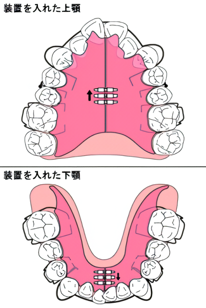 フレンド歯科では成長期のお子様に適した床矯正に対応しています