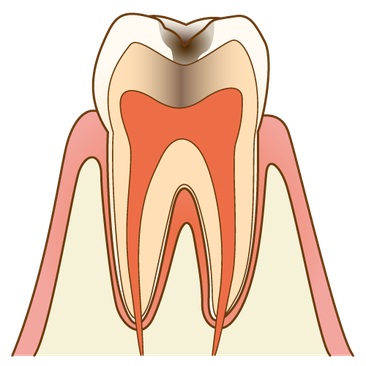 虫歯治療は段階によって治療法が異なります