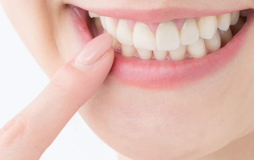 セラミックとホワイトニングで叶える理想の口元と自然な白さ