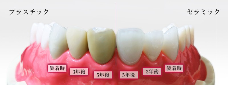 プラスチックとセラミックの違い