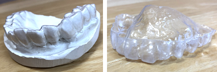 カバースプリントによる治療