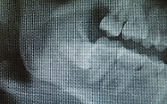 親知らずの抜歯にも力を入れています