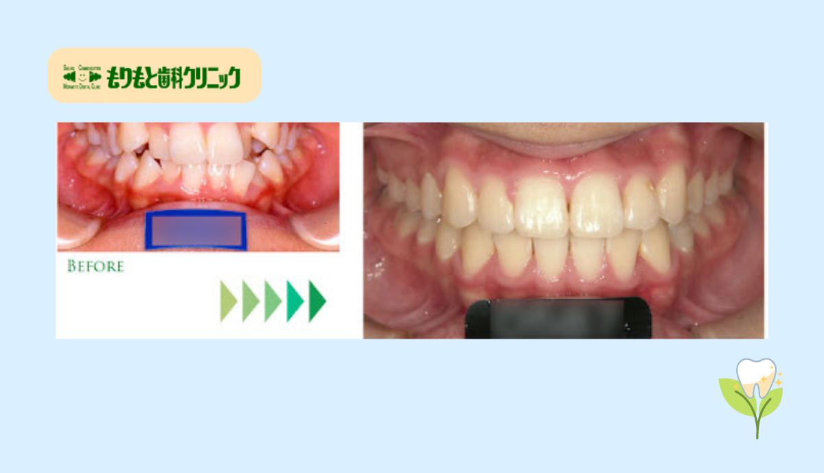 機能面と審美性を追求した矯正歯科治療