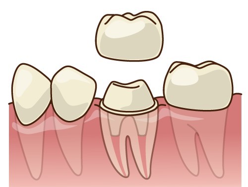 補綴物は装着して終わりではなく、その後の状態を丁寧に確認しながら管理を続けることで、安定した状態を長く保てるよう配慮しています。※写真はイメージです。