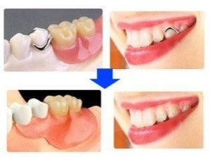 機能性と耐久性に優れた義歯治療を提供しています