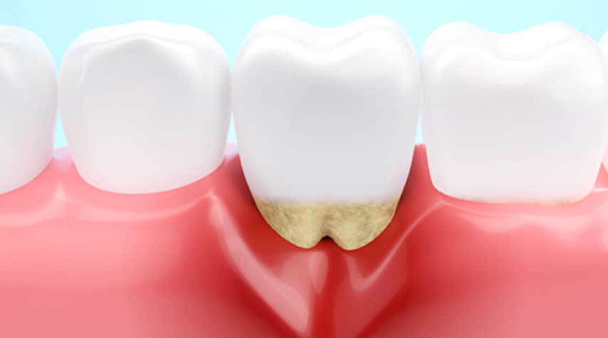 歯を失わないために