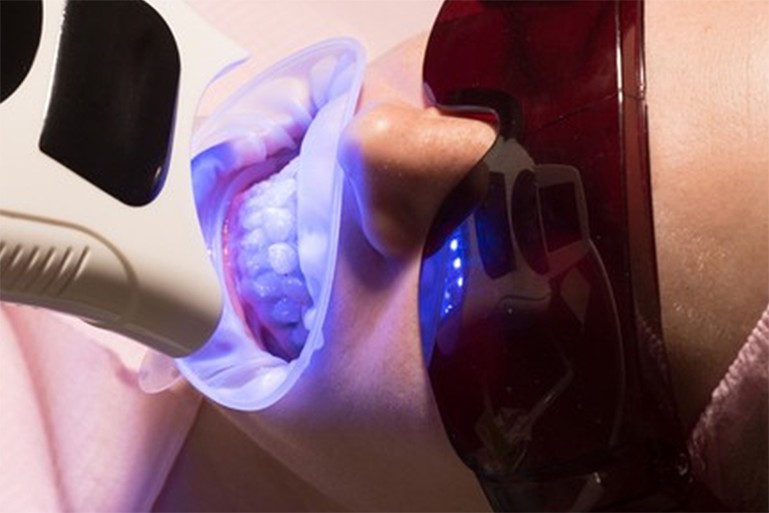 ホワイトエッセンス加盟院として、ホワイトエッセンスの薬剤を使ったホワイトニングと、それに続くクリーニングを提供しています