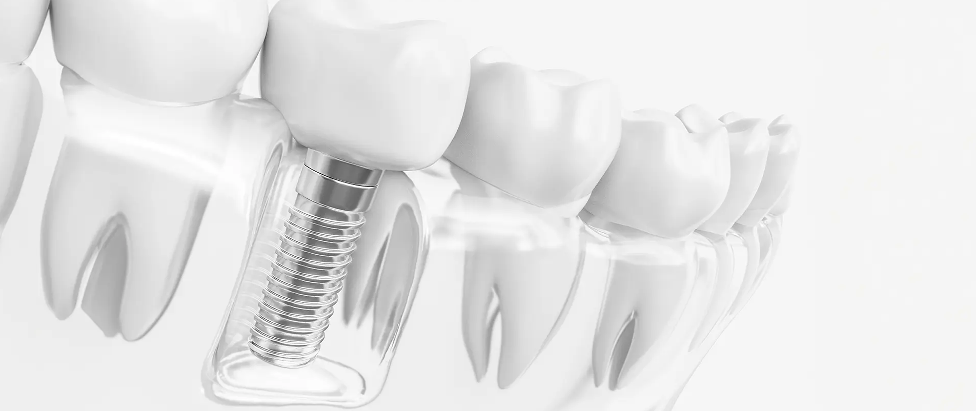 患者さま一人ひとりの状況に応じた安全で精密なインプラント治療を行っています