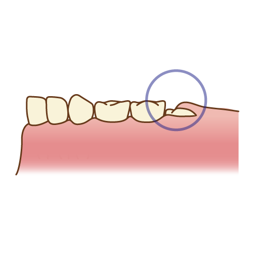 親知らずの痛み、いしだ歯科クリニックが解決します