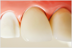 金属アレルギーの方もご利用いただけます