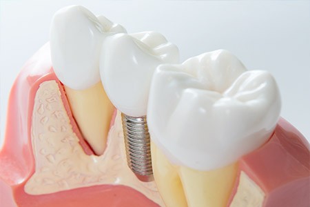 長く安心して噛める毎日を支える