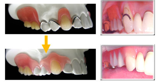 従来の入れ歯より自然な入れ歯があります