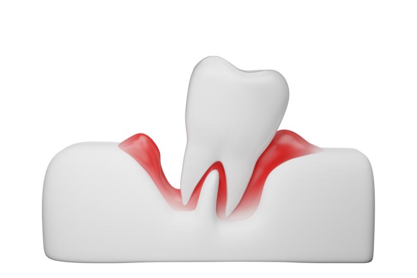 歯周病は単に口腔内の問題に留まらず、全身健康にも影響を及ぼす可能性がある深刻な疾患です。