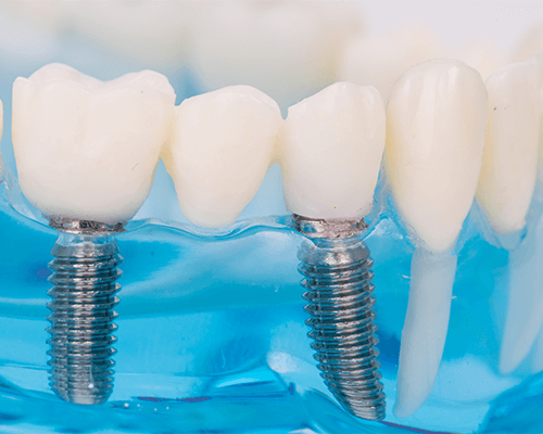 天然歯のように噛める、インプラント治療
