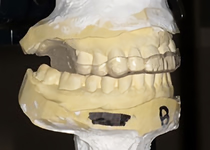 スプリントを用いた治療を提供