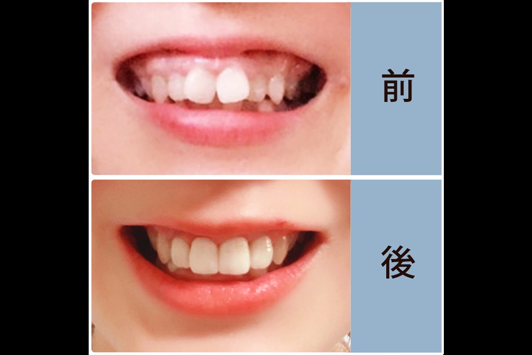 本物の歯と見分けがつかないほど自然な見た目です