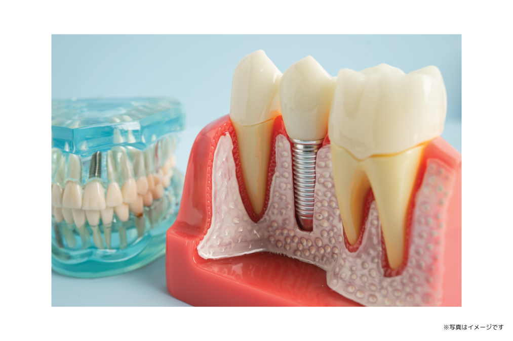 人工歯根によって自然な噛み心地を支えています